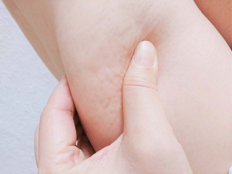 橘皮纹是怎么形成的?分享10个消除橘皮组织的方法